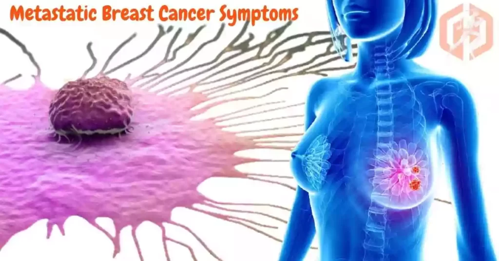 What are the Metastatic breast Cancer Symptoms and best treatment