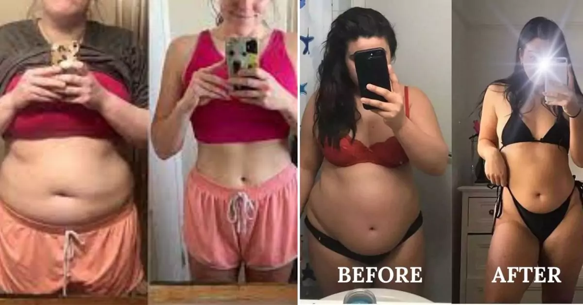 Weight Loss After Hiatal Hernia Surgery Achieve Dream Figure